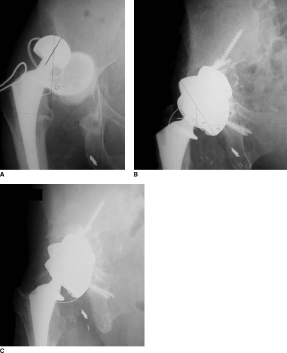 Pelvic Discontinuity | Musculoskeletal Key