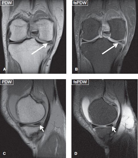 The Knee | Musculoskeletal Key