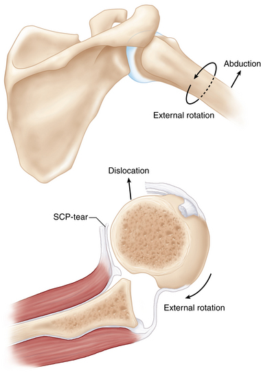 Recognition and management of combined instability and rotator cuff ...