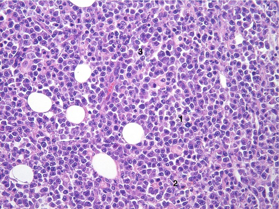 Primary Lymphoma Of Bone | Musculoskeletal Key