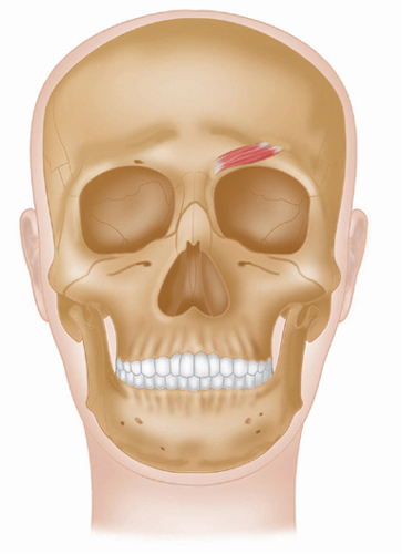 Corrugator supercilii