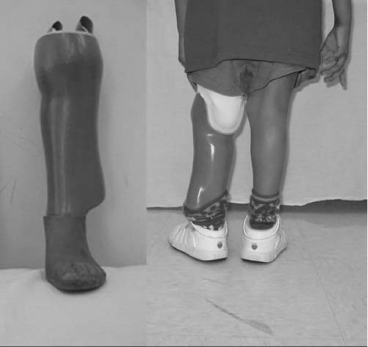 Pediatric Limb Deficiencies | Musculoskeletal Key