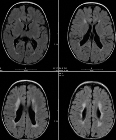 cerebral palsy brain scan