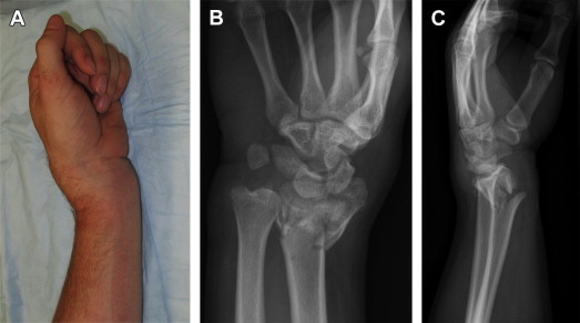 Wrist distal radius fracture - gulfsheet