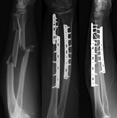 Forearm Fractures | Musculoskeletal Key