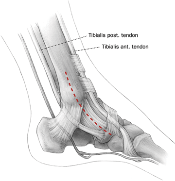 Talus fracture