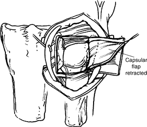 cpt code scapholunate ligament tear repair