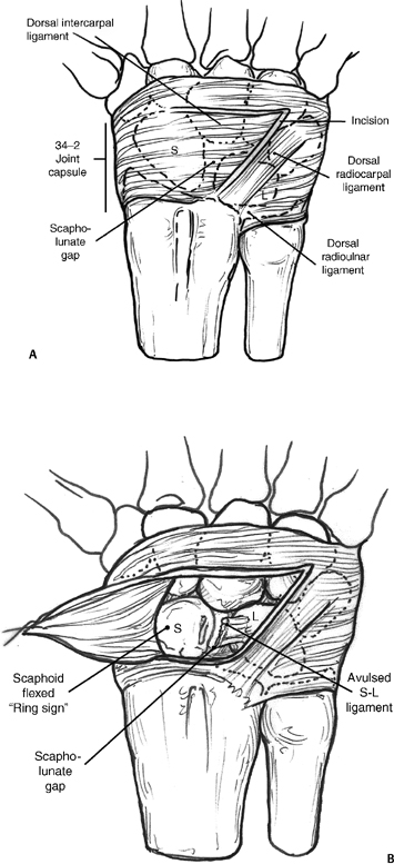 Scapholunate Ligament Anatomy 4072