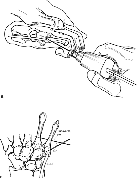 Closed Reduction And Internal Fixation Of Reverse Bennett’s Fractures ...