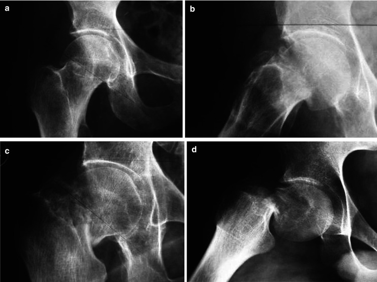 Femoral Neck Fractures Musculoskeletal Key