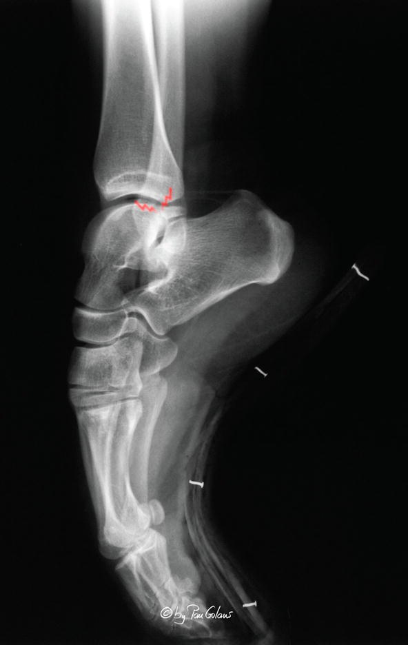 Posterior Ankle Impingement | Musculoskeletal Key