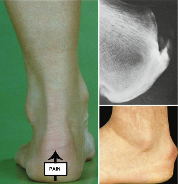 Deltoid Ligament Pathology Treated by Means of a Two-Portal Hindfoot  Approach