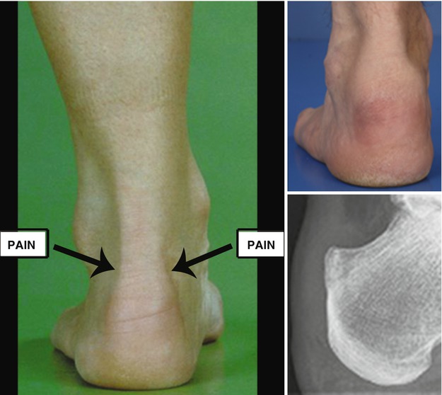 Endoscopic Calcaneoplasty Musculoskeletal Key