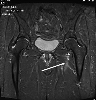 Surgical Treatment of Sports Hernia: Laparoscopic Approach