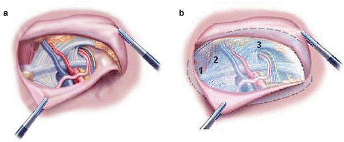 Tapp Inguinal Hernia Repair Anatomy Anatomy Structure