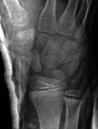 complete bone fracture