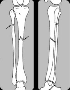 The diagnosis of fractures and principles of treatment ...