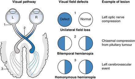 Stroke Visual Field Stroke Visual Field
