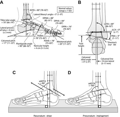 Osteotomy For Realignment Of The Ankle Joint Musculoskeletal Key