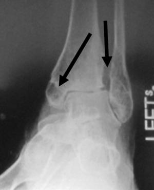 pain intermittently lateral malleolus fracture