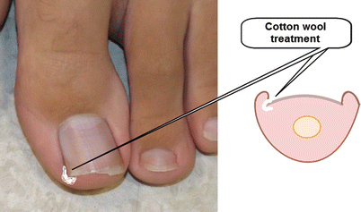 ingrown toenail healing