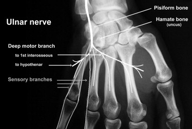 Posture of Mrs. M.'s hand two months post- injury. ( A ) Wrist and