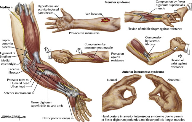 Diagnosis and Treatment of Work-Related Proximal Median and Radial
