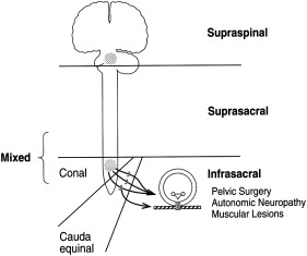 Neurogenic Bladder In Spinal Cord Injury Musculoskeletal Key