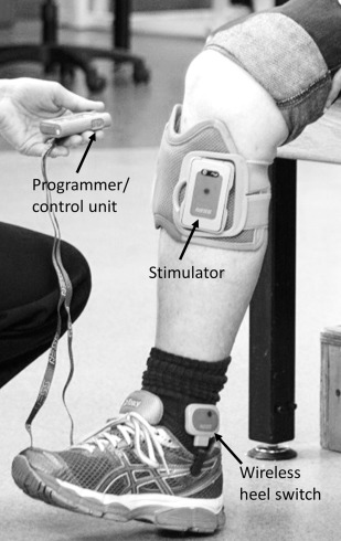 Neuromuscular Electrical Stimulation (NMES) for foot drop