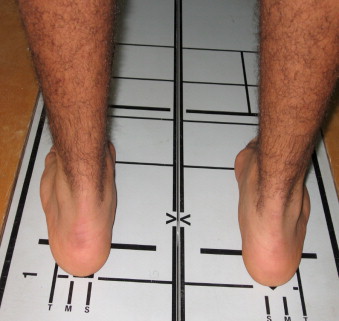 Single-leg Assessment Of Postural Stability And Knee Functional Outcome ...