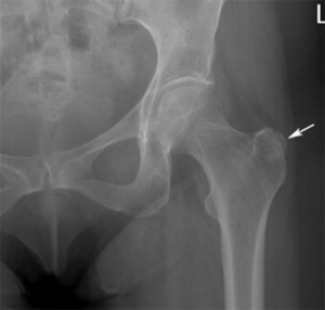 Greater Trochanteric Pain Syndrome Diagnosis And Treatment ...