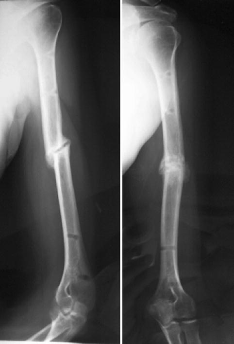 Humeral Shaft Fractures And External Fixator | Musculoskeletal Key