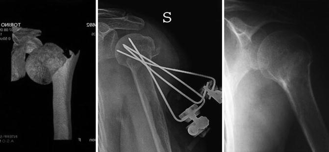 Percutaneous Fixation: When And How | Musculoskeletal Key