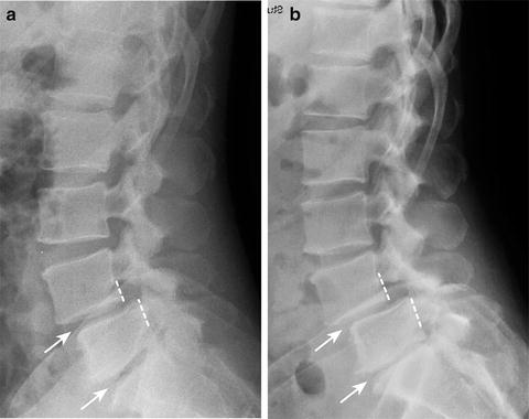 Imaging Techniques For The Diagnosis Of Spondylolisthesis ...