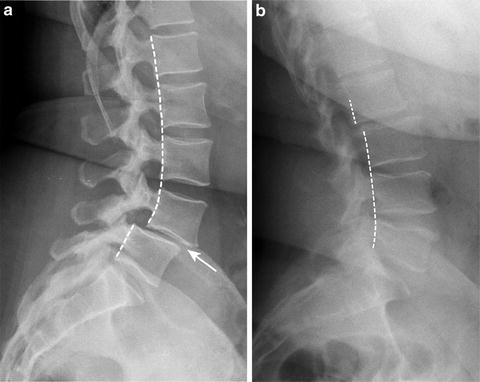 Imaging Techniques For The Diagnosis Of Spondylolisthesis ...