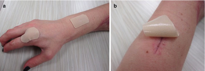 Rehabilitation Following Replantation In The Upper Extremity ...