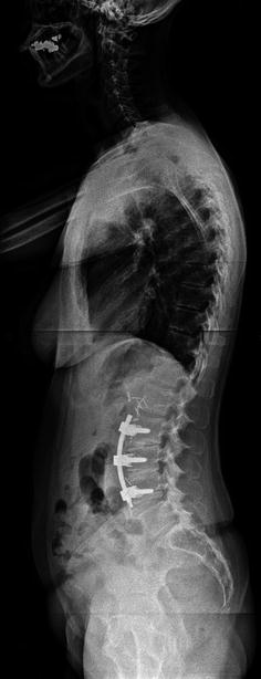 Oblique Lumbar Interbody Fusion Musculoskeletal Key