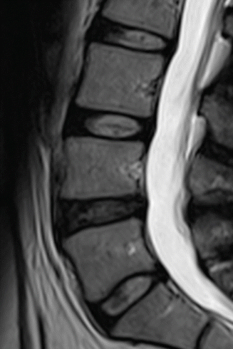 Imaging Of Degenerative Disk Disease | Musculoskeletal Key