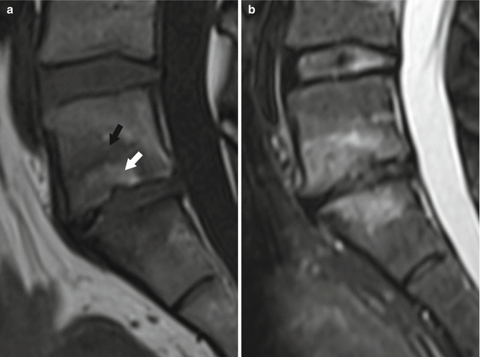 Imaging Of Degenerative Disk Disease | Musculoskeletal Key