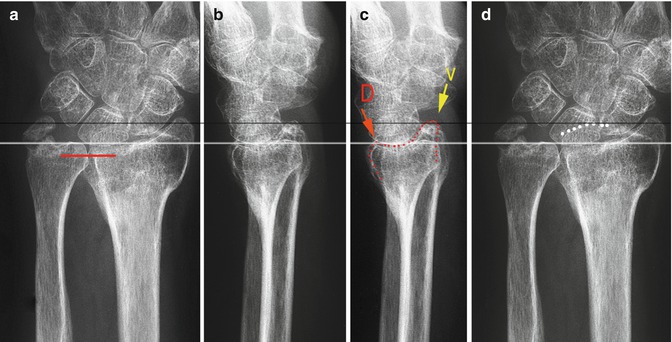 Distal Radius Malunion | Musculoskeletal Key