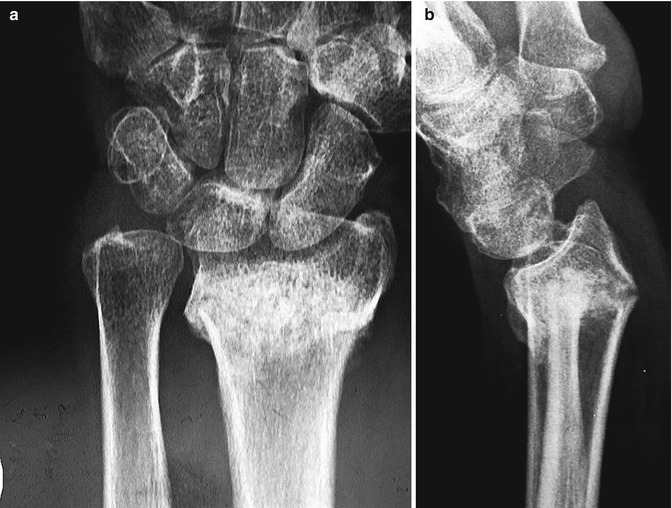 Distal Radius Malunion | Musculoskeletal Key