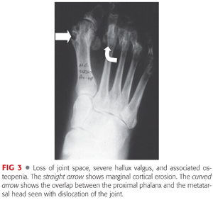 Rheumatoid Forefoot Reconstruction | Musculoskeletal Key