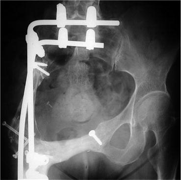 Limb Salvage Surgery For Pelvic Osteosarcoma | Musculoskeletal Key