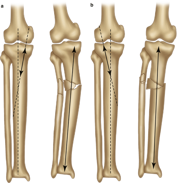 Proximal Tibia | Musculoskeletal Key