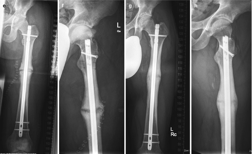 Nonunion | Musculoskeletal Key