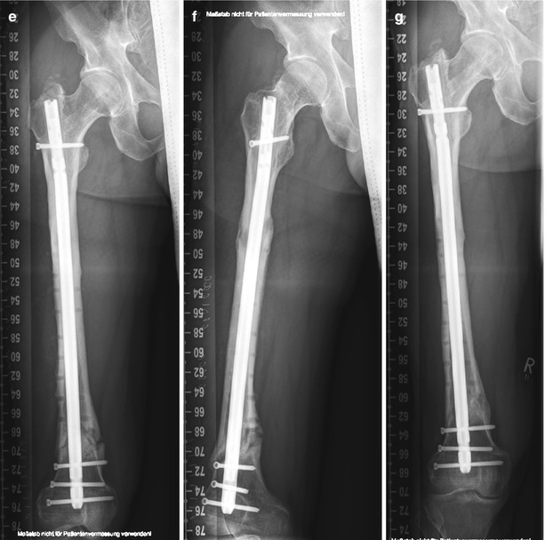 Nonunion | Musculoskeletal Key