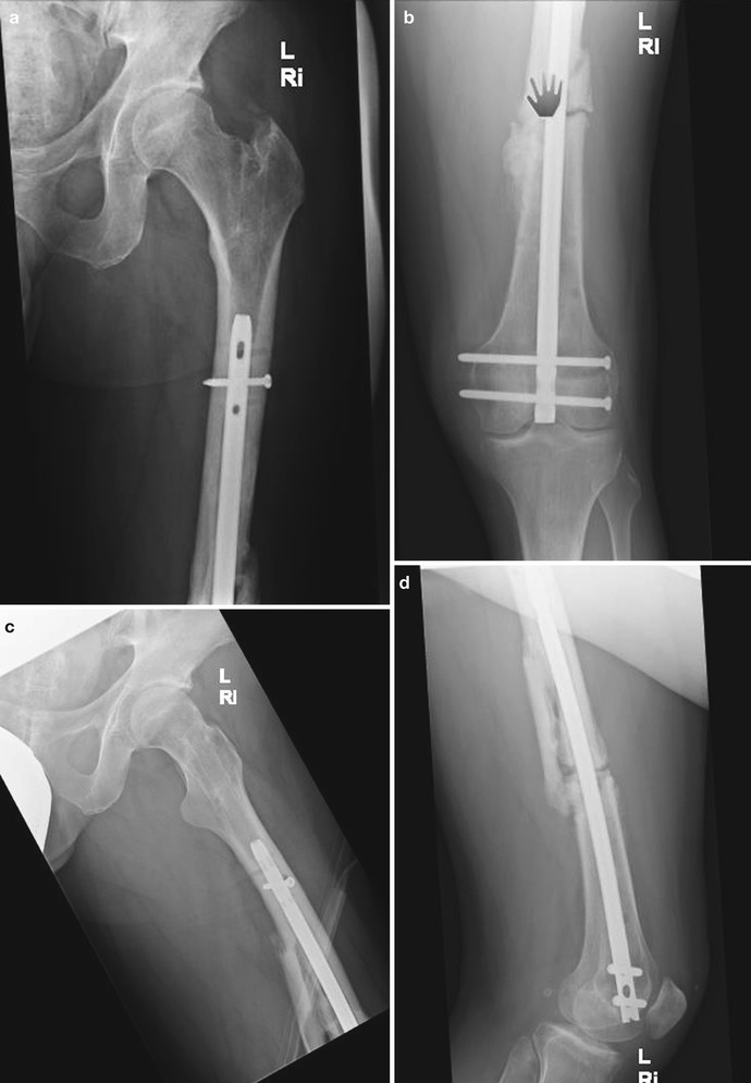 Nonunion | Musculoskeletal Key