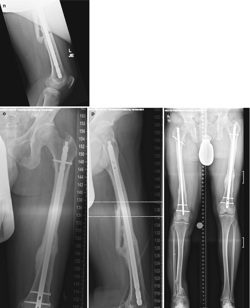 Nonunion | Musculoskeletal Key