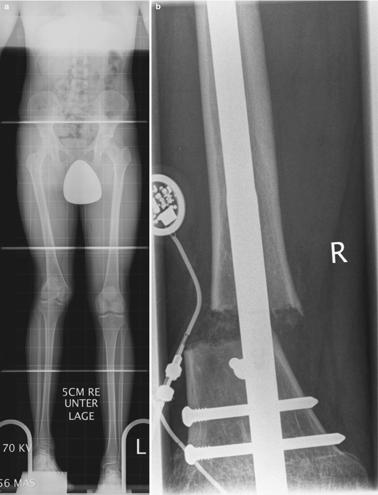 Limb Lengthening: Computerized | Musculoskeletal Key