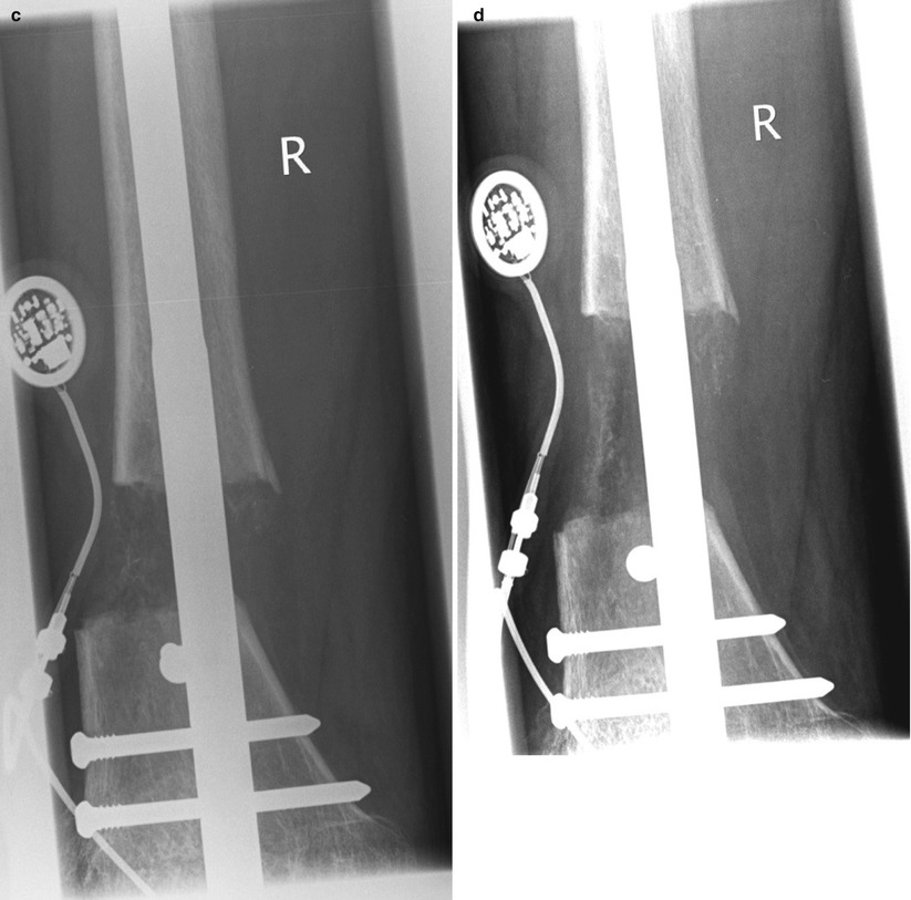 Limb Lengthening: Computerized | Musculoskeletal Key